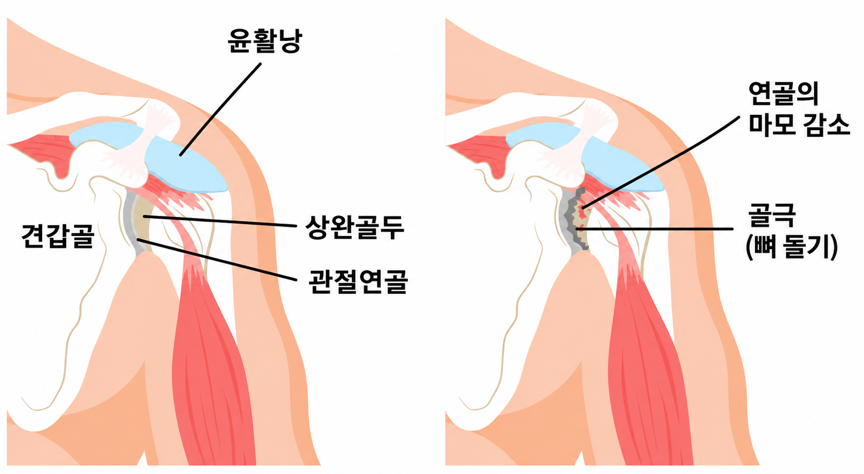 퇴행성 어깨관절증의 원리