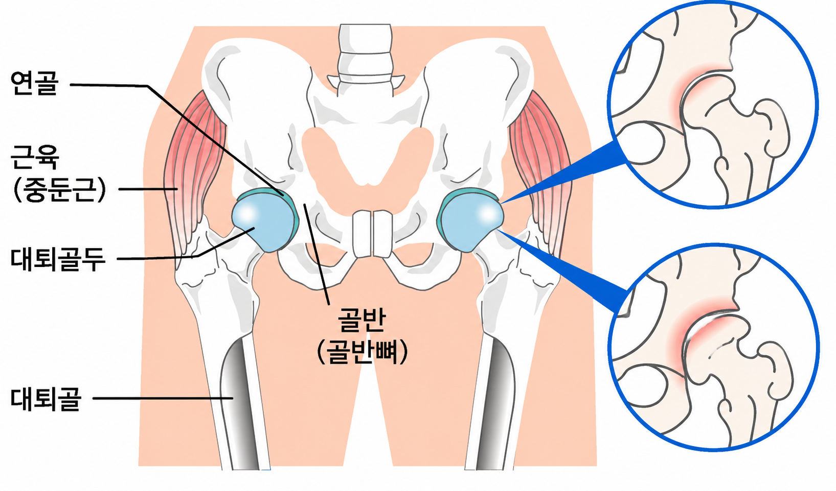 퇴행성 고관절증의 원리