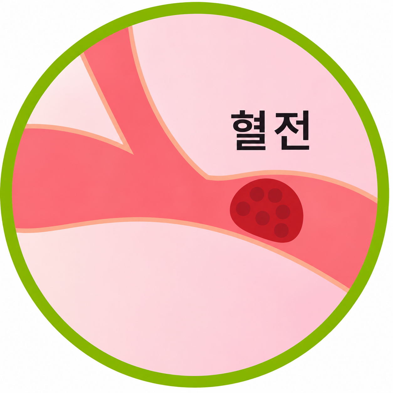 뇌경색(혈전)