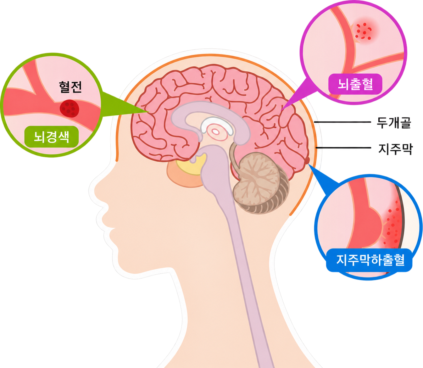 뇌경색·뇌출혈·지주막하출혈의 발생 부위