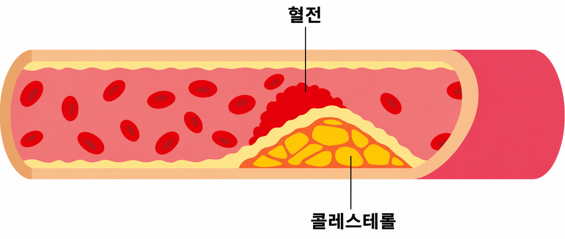 혈전과 콜레스테롤이 쌓인 혈관