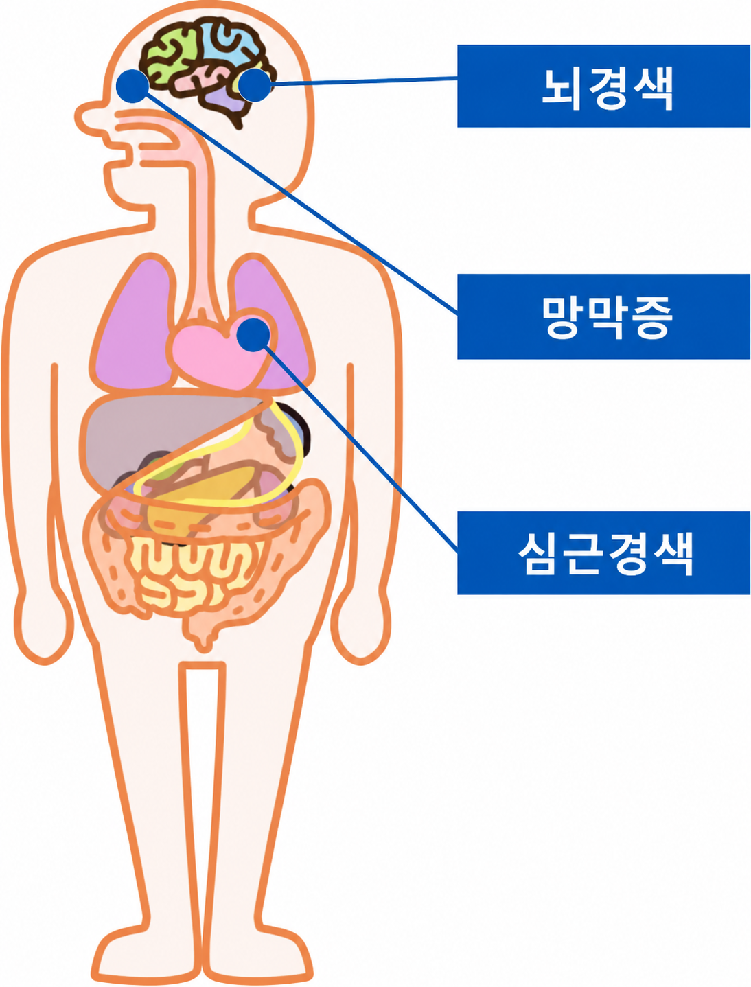 당뇨병의 합병증: 뇌경색·망막증·심근경색